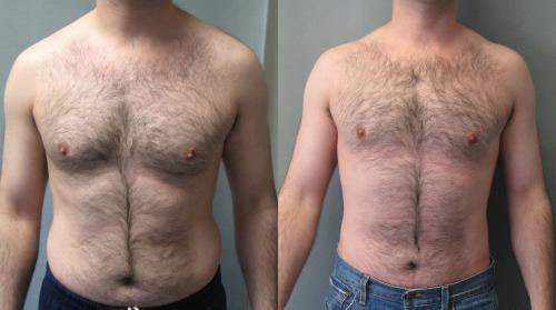 Gynecomastia with Liposuction Gynecomastia with Liposuction