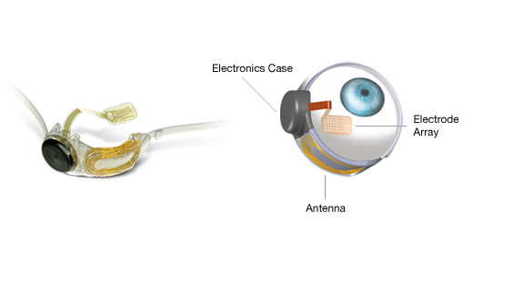 The Argus II artificial retina can restore a form of sight to patients with retinitis pigmentosa. Image courtesy of Second Sight Medical Products.